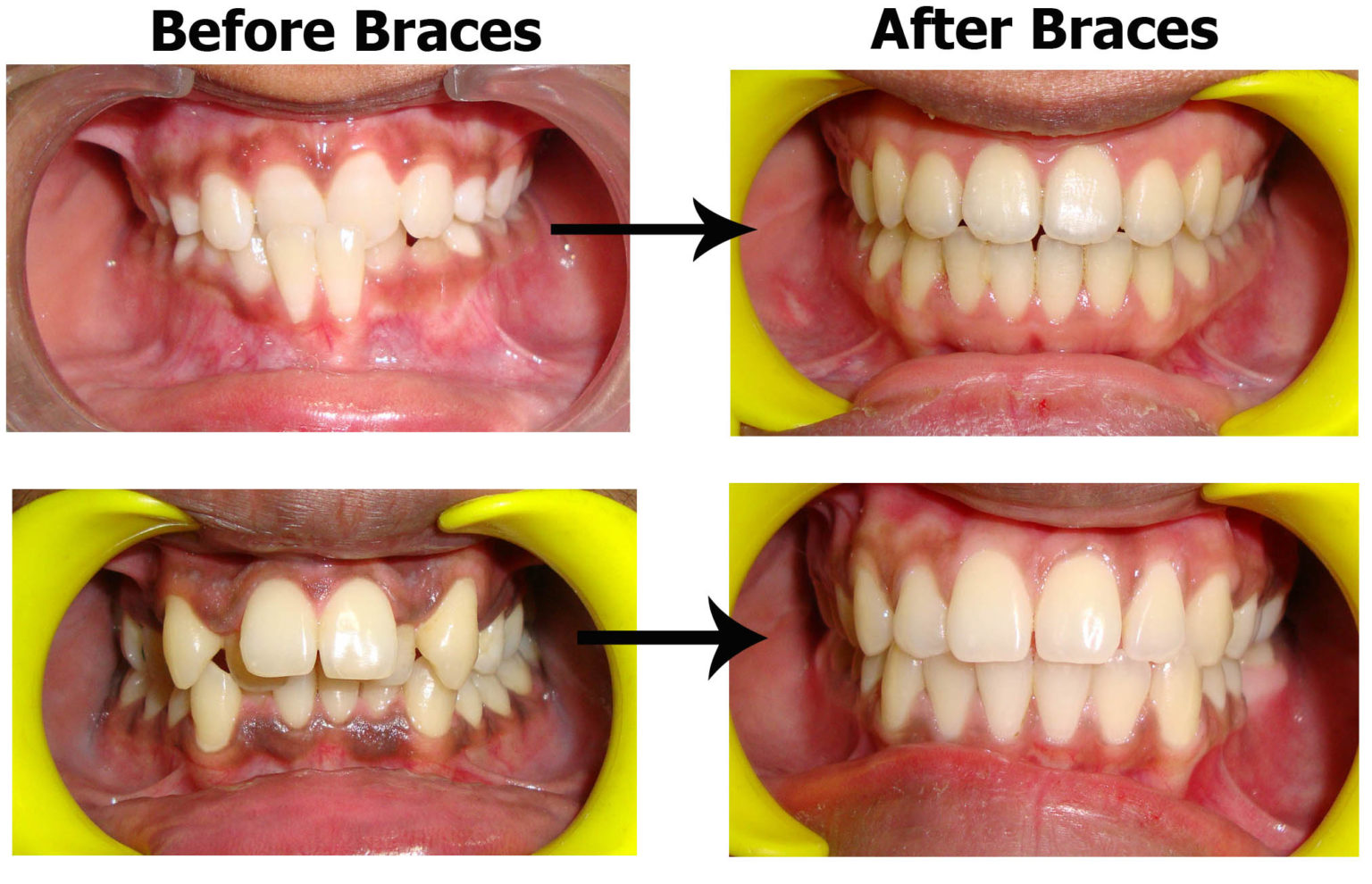 Best Dentist in South Delhi for Braces Dental Treatment Braces