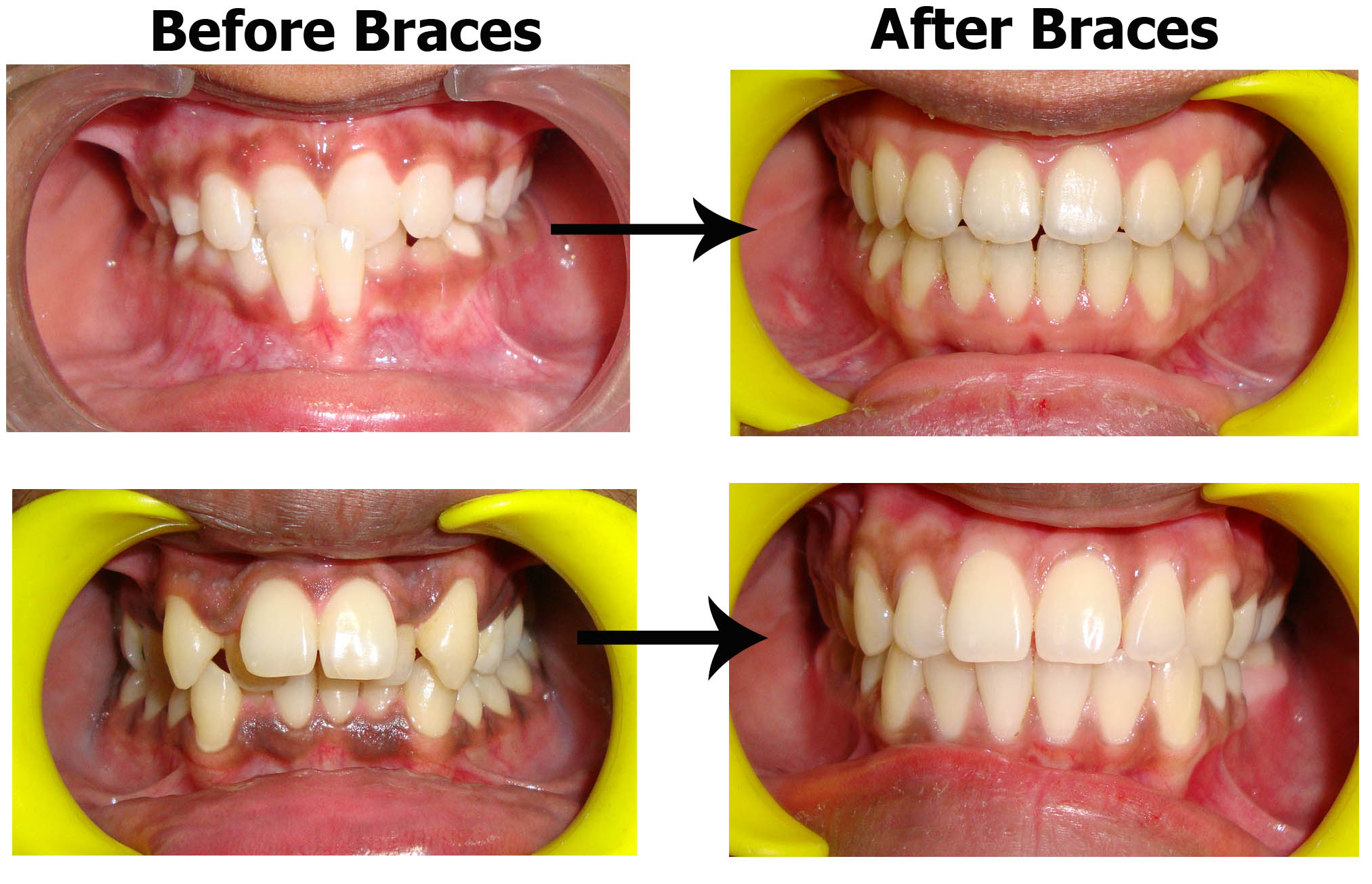 Best Dentist in South Delhi for Braces Dental Treatment Braces Maximus Dental