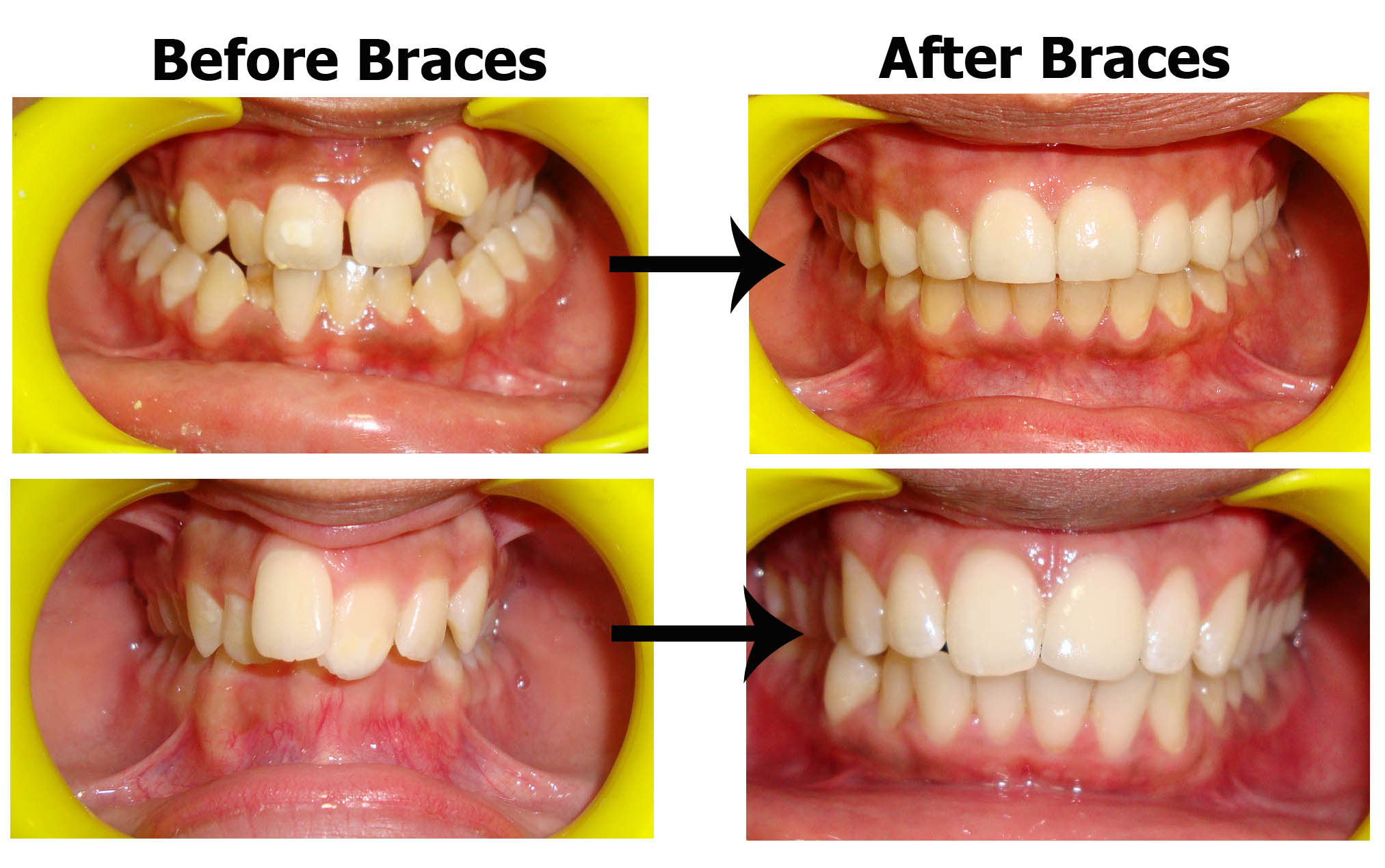Best Dentist in South Delhi for Braces Dental Treatment Braces