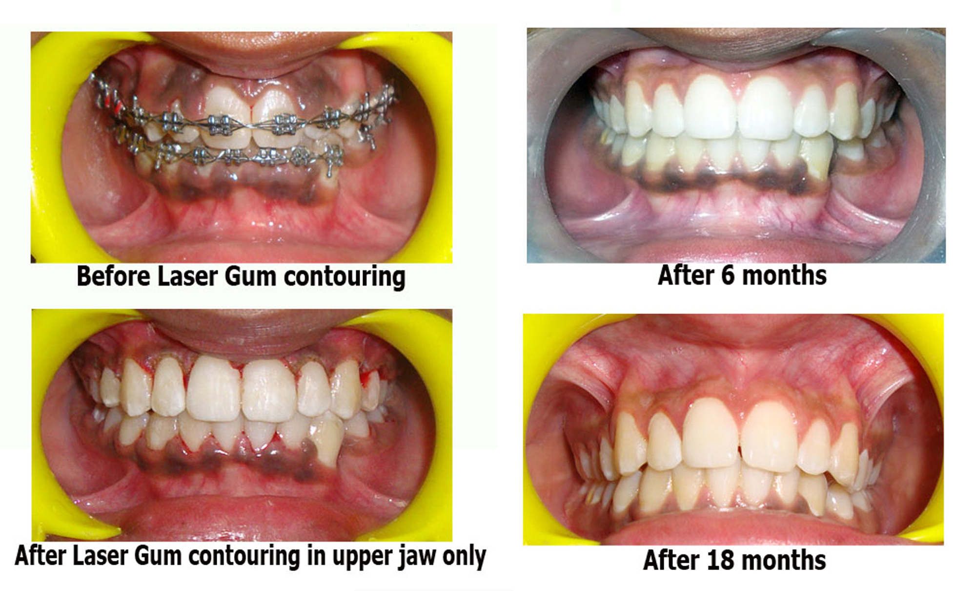 Best Dental Center for Gums Treatment in South Delhi Maximus Dental