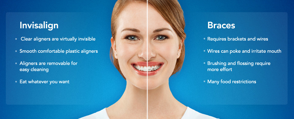 https://www.maximus-dental.com/wp-content/uploads/2020/01/invisalign-1.jpg